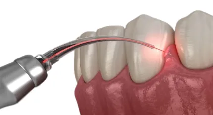 Soft Tissue Growth Removal